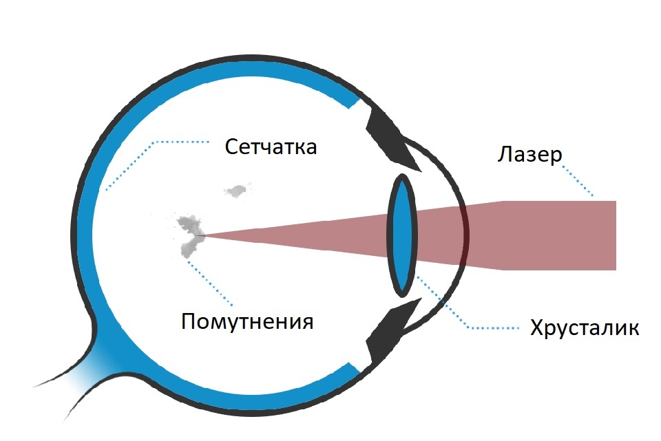 Схема процедуры лазерного витреолизиса