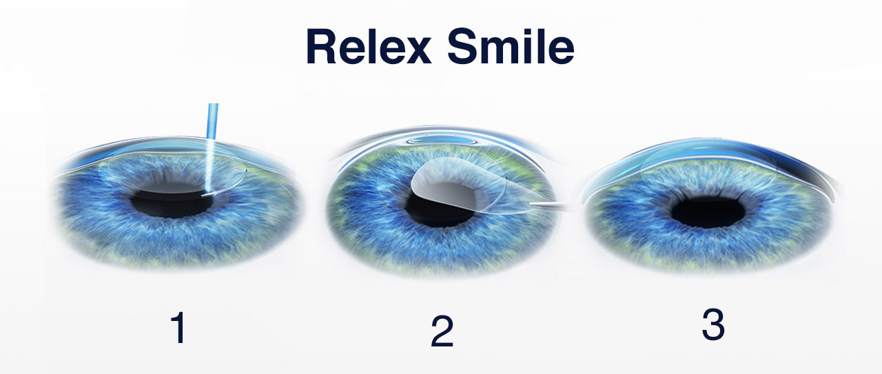 ReLEx SMILE