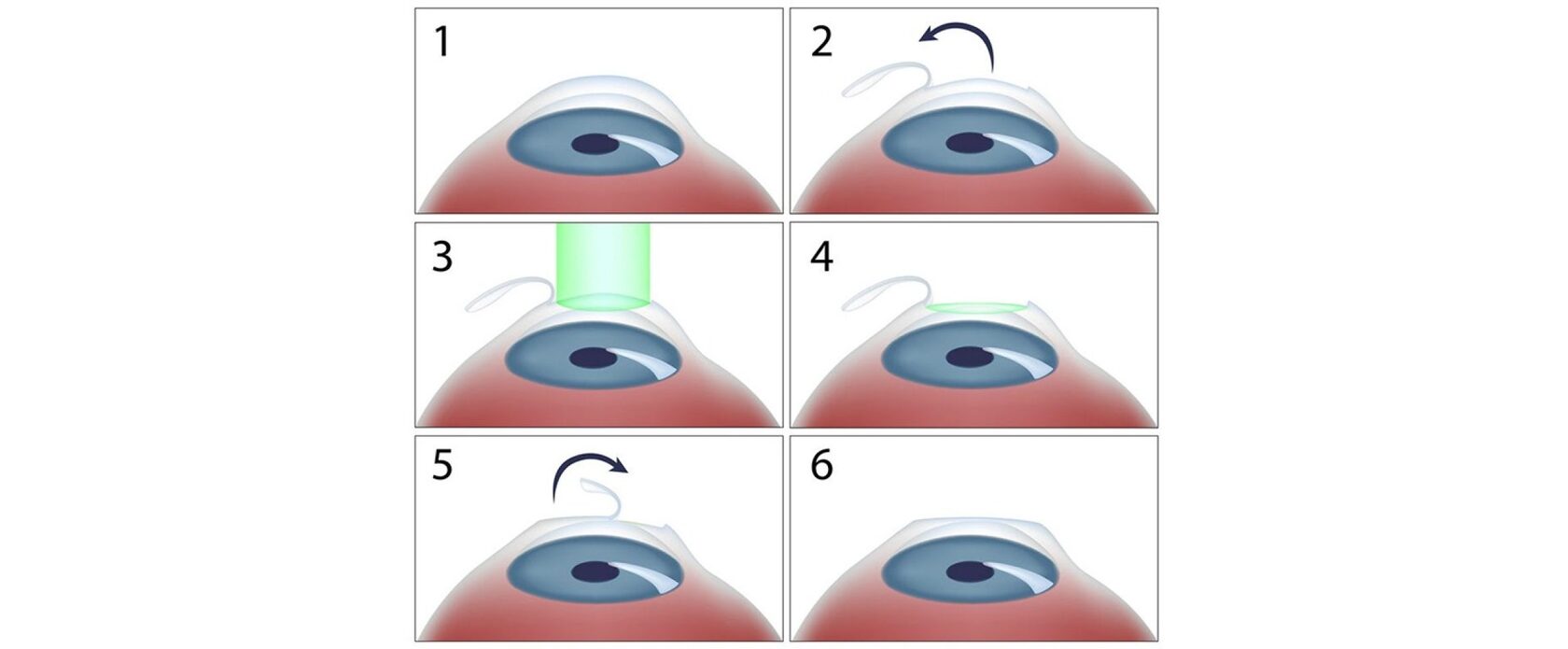LASIK
