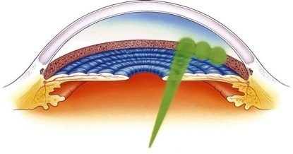 Глаукома